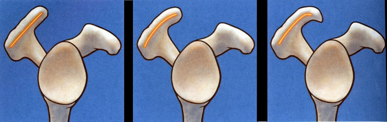 Classification de Bigliani — morphologie de l'acromion