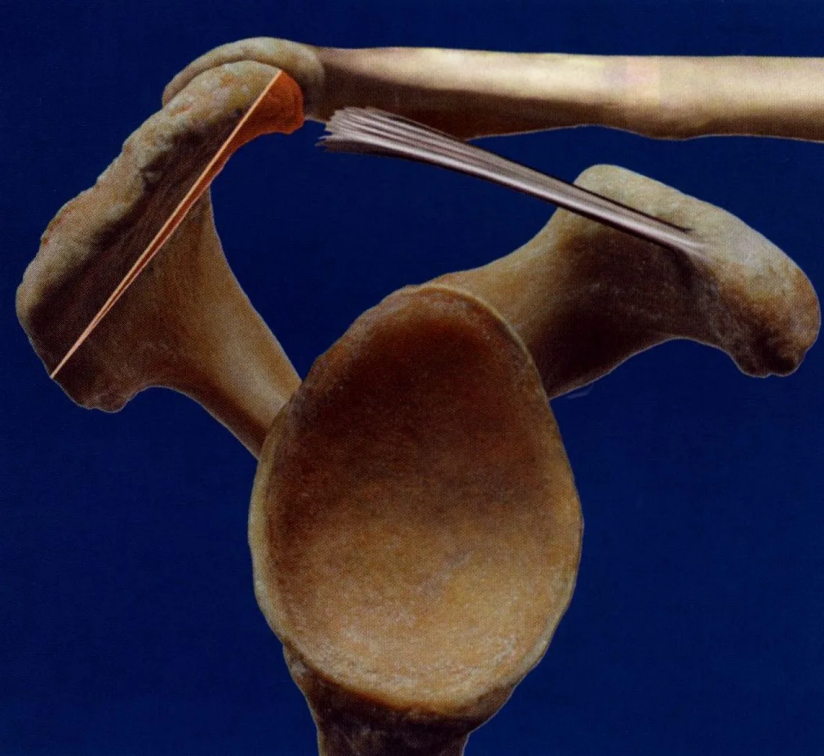 Acromioplastie sous arthroscopie