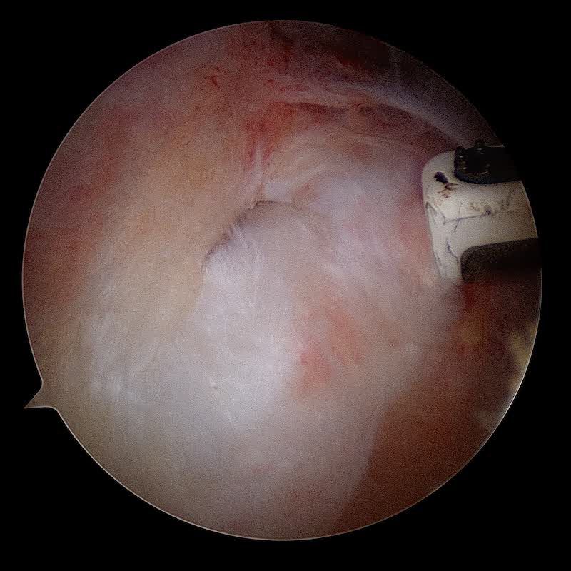 Lésion du supraspinatus