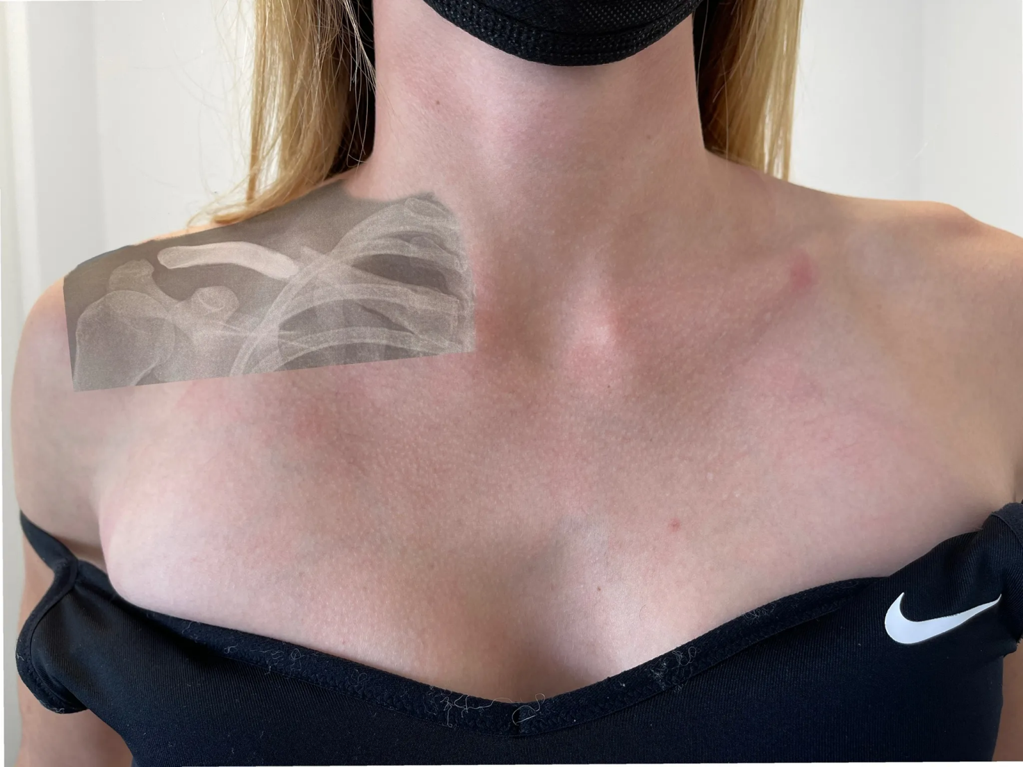 cicatrice fracture clavicule