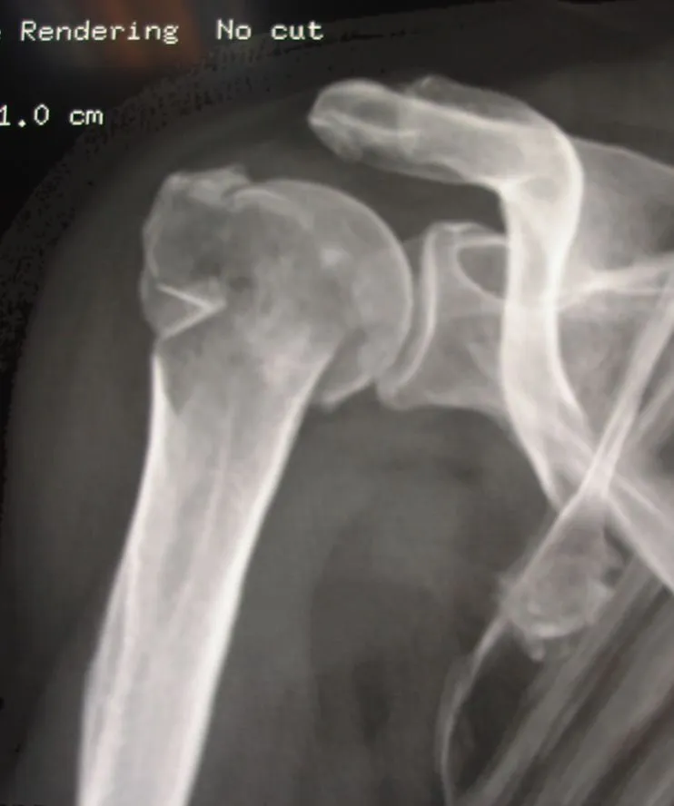 Fracture Neer 4 fragments