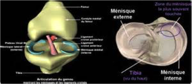 Types de lésions méniscales genou Montpellier