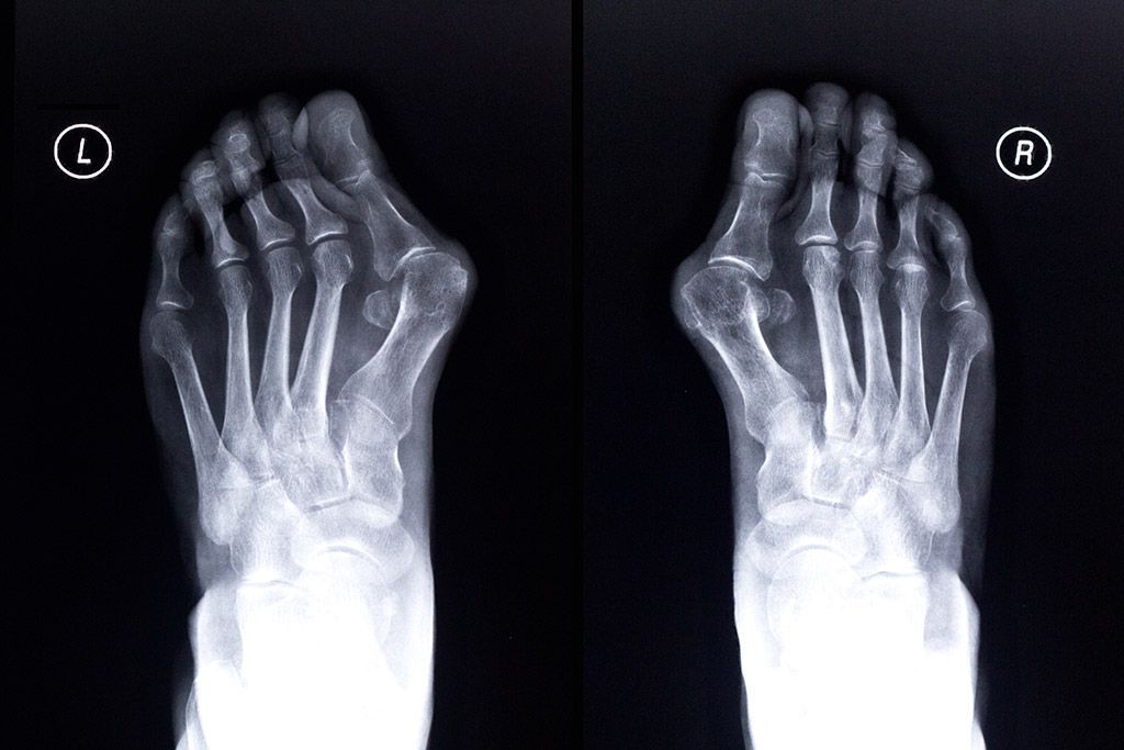 radiographies hallux valgus