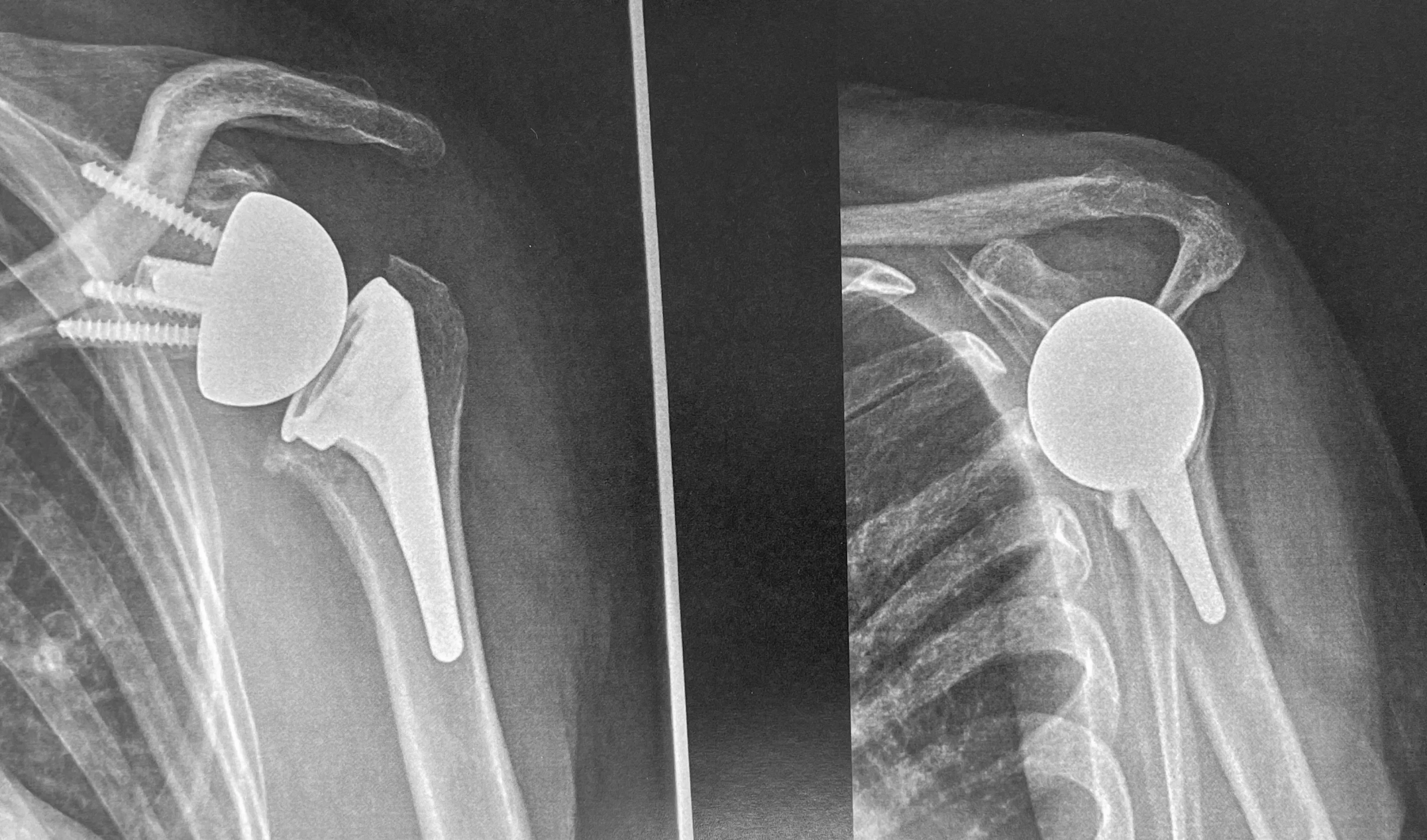 prothèse totale inversée de l'épaule