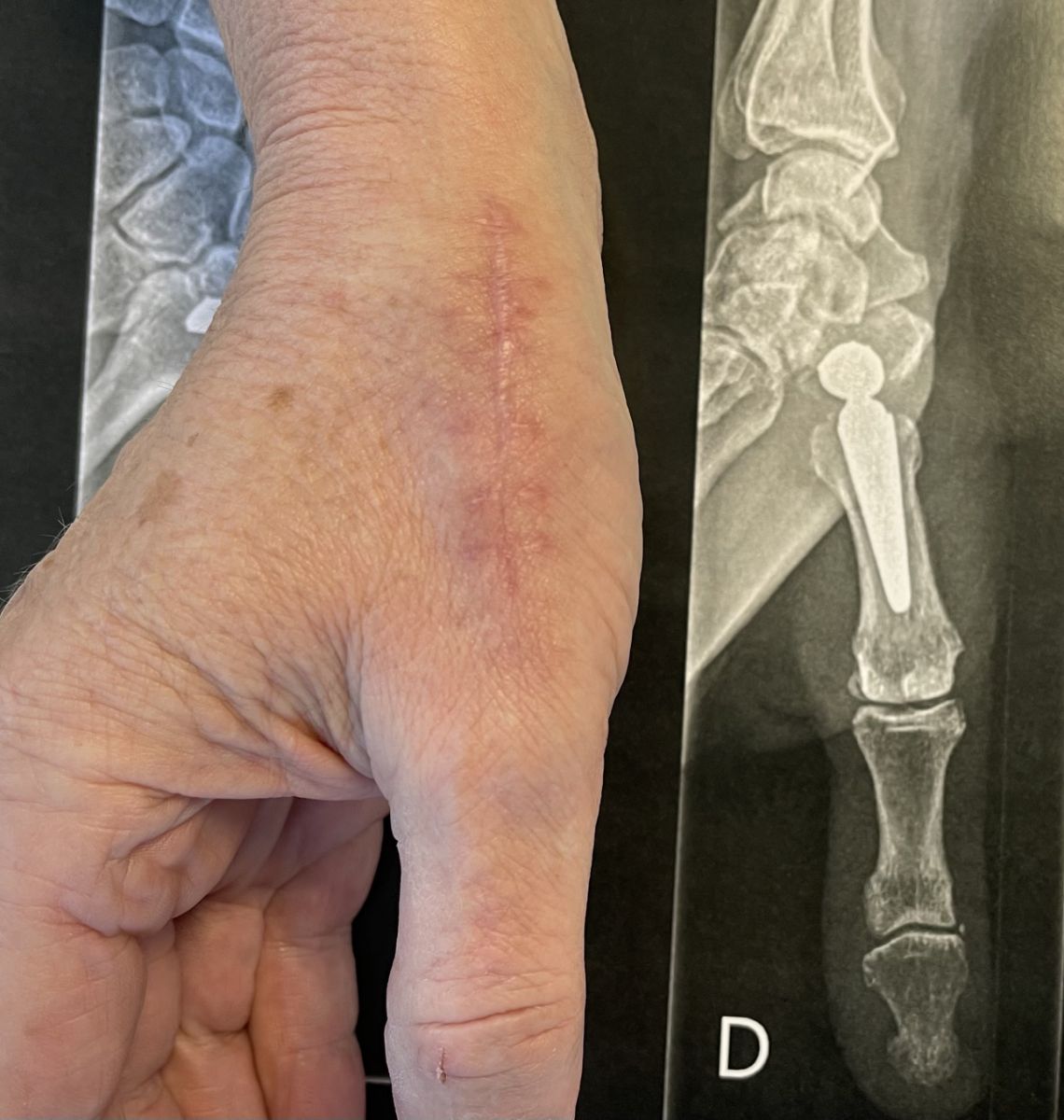 Prothèse trapézo-métacarpienne — cicatrice et radiographie post-opératoire