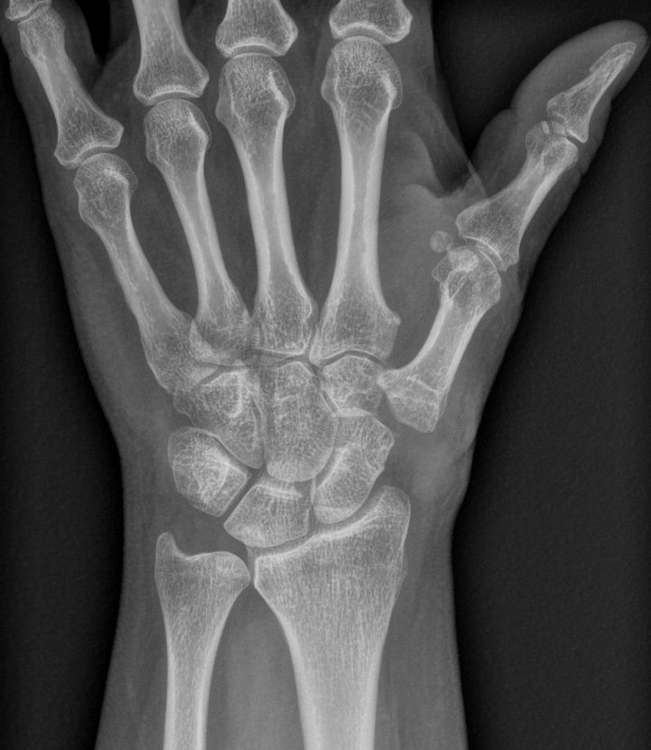 Radiographie après trapézectomie du pouce
