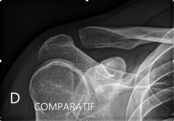 Radiographie articulation acromio-claviculaire normale
