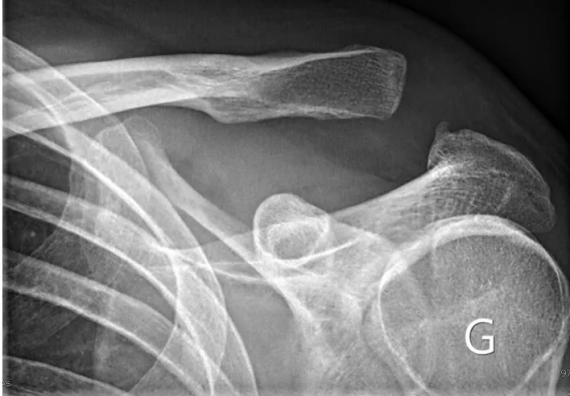 Luxation acromio-claviculaire