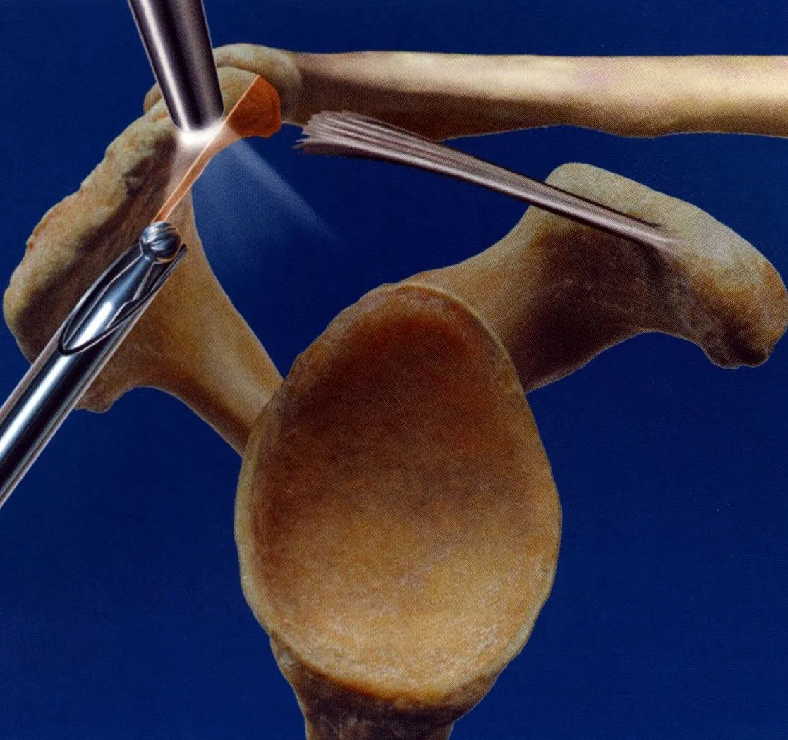 Résection acromion sous arthroscopie