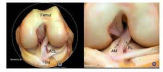 Ligament croisé antérieur LCA du genou