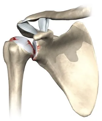 Arthrose de l'épaule