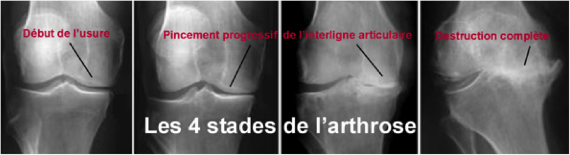 Classification arthrose du genou gonarthrose Montpellier