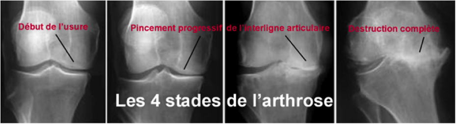 classification arthrose du genou