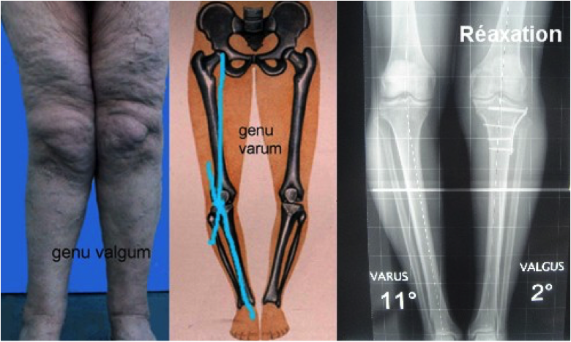 Genu varum arthrose genou Montpellier