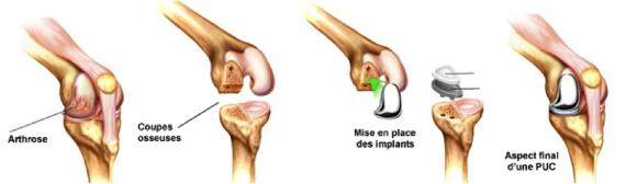 Prothèse uni-compartimentaire PUC genou Montpellier