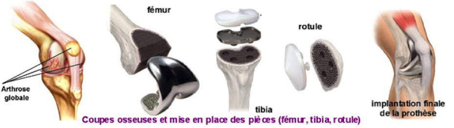 prothèse totale du genou