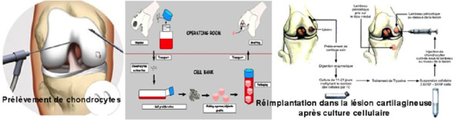 greffe de chondrocytes