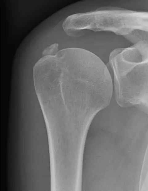 Calcification de l'épaule — radiographie montrant un dépôt calcique dans le tendon supra-épineux