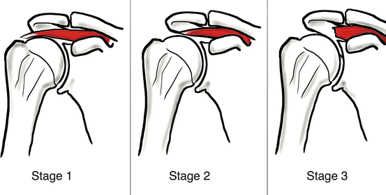 classification des ruptures de la coiffe