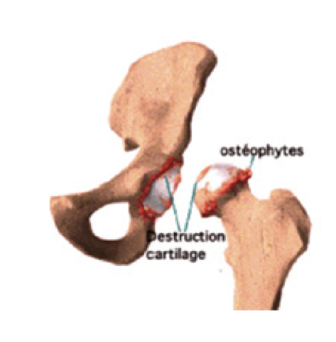 coxarthrose