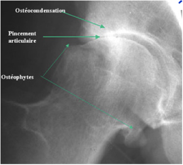 hanche arthrosique