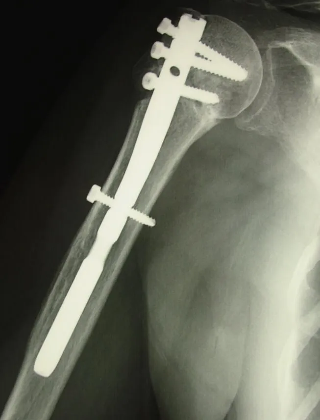 Enclouage fracture humérus