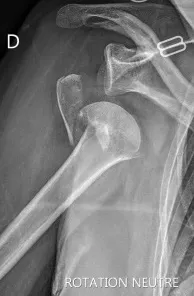 Fracture-luxation de l'épaule