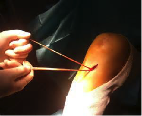 prélèvement tendon