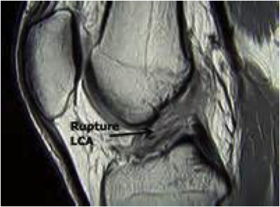 rupture lca irm