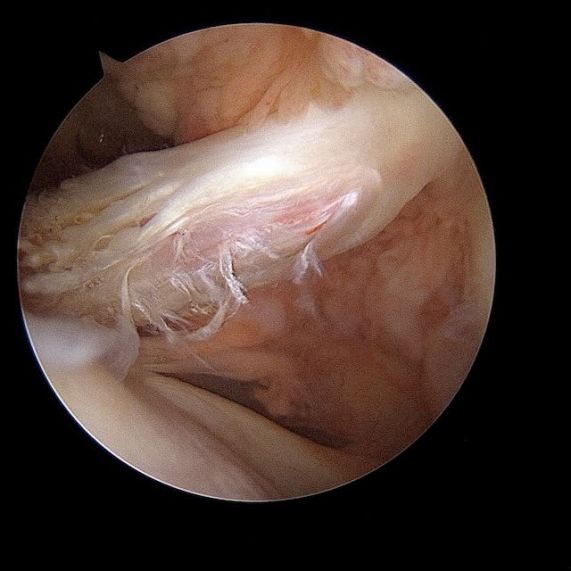Tendon du long biceps d&eacute;lamin&eacute; vu sous arthroscopie