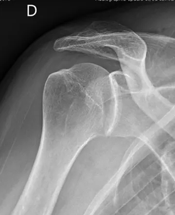 luxation postérieure de l'épaule