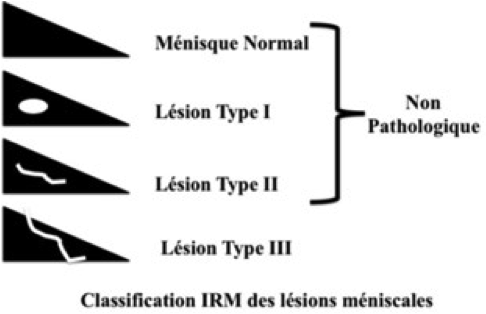 IRM ménisque normal genou Montpellier