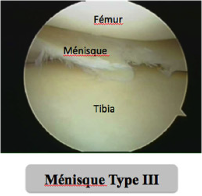 Arthroscanner ménisque genou Montpellier