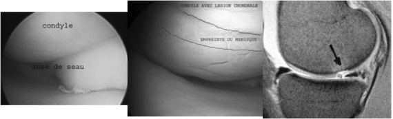 Lésion méniscale traumatique genou Montpellier
