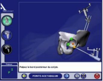 Modèle 3D peropératoire — Bone Morphing