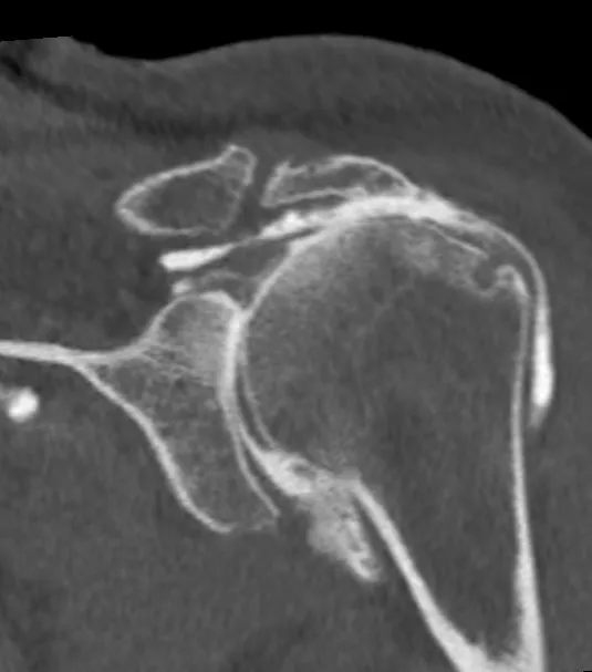 omarthrose secondaire