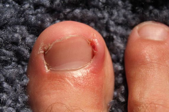 Ongle incarné du gros orteil — inflammation du bourrelet latéral