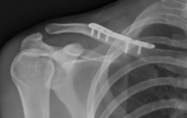 Plaque claviculaire