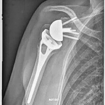 Prothèse inversée pour fracture
