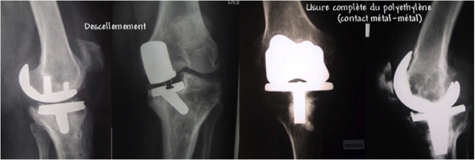 reprise de prothèse totale du genou