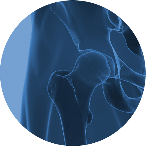 arthroscopie de la hanche