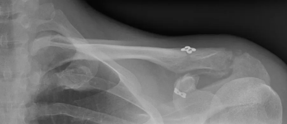 Endobutton acromio-claviculaire radiographie