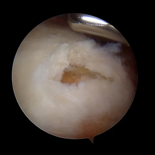 réparation arthroscopique de la coiffe des rotateurs docteur roussanne