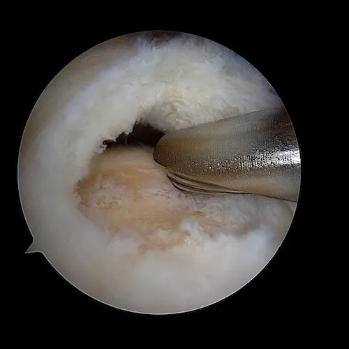 préparation footprint supraspinatus