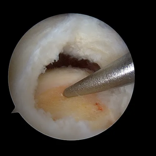 mise en place ancre trochiter