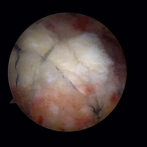 Réparation complète du supraspinatus
