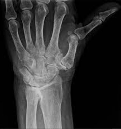 Radiographie de rhizarthrose — arthrose du pouce