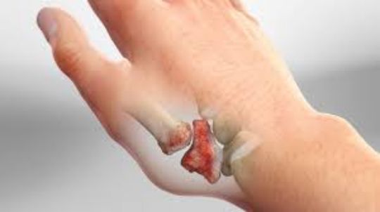 Rhizarthrose — arthrose de la base du pouce