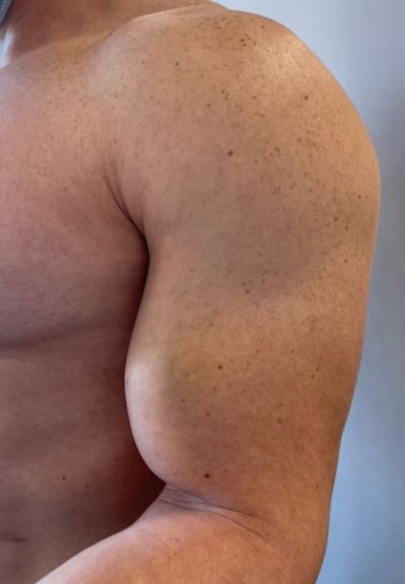 Signe de Popeye : bosse du biceps apr&egrave;s rupture du long biceps